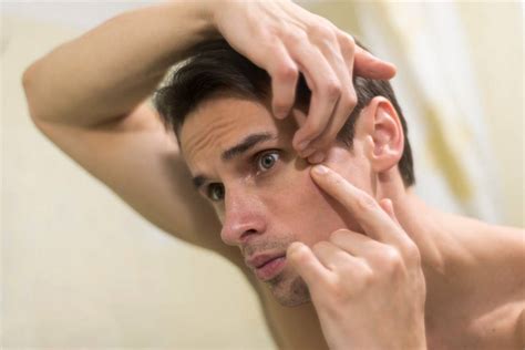 Tackling Acne Effective Strategies And Products For Adult Men