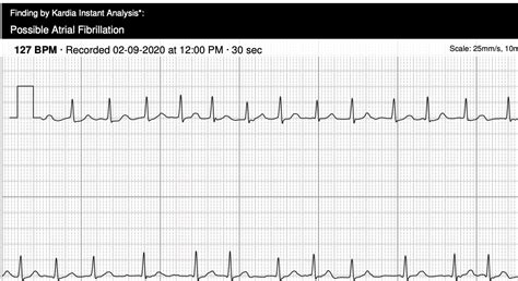 Alivecor S Kardia Mobile Ecg Accurately Identifies Atrial Fibrillation 120 Bpm The Skeptical