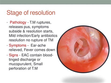 Acute Otitis Media