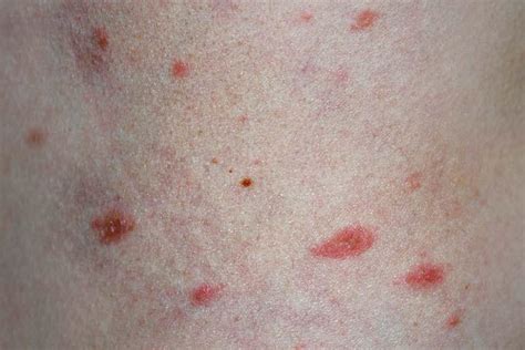 Pityriasis Rosea Herald Patch On Leg