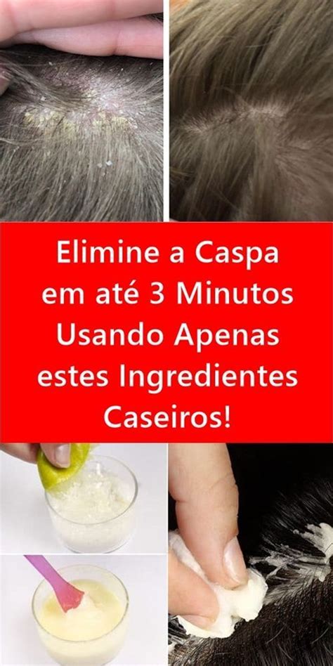 Elimine a Caspa em até 3 Minutos Usando Apenas estes Ingredientes