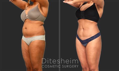 Lipo Charlotte Nc Ditesheim Cosmetic Surgery