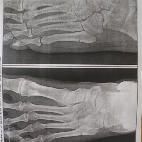 Можно ли через четыре недели снять гипс при переломе пятой плюсневой ...