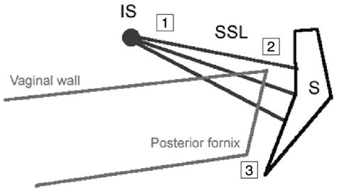 Medial Sacrospinous Attachment With Posterior Intravaginal Sling