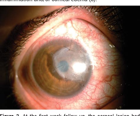 Figure From Management Of Corneal Pannus Caused By Late Stage