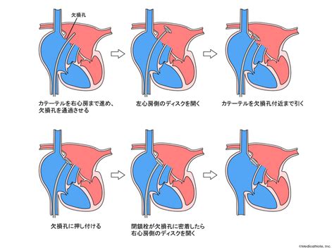 心房中隔欠損症に対する心臓カテーテル治療“asd閉鎖術” メディカルノート