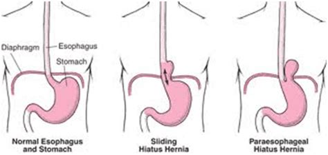 Hiatal Hernia Surgery Overview - Santa Monica, CA & Encino, CA