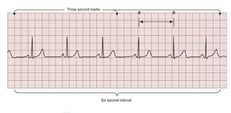 Ekg Practice Flashcards Quizlet