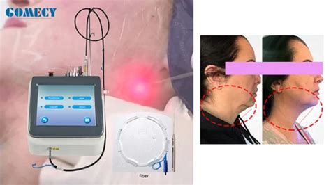 Minimal Invasive Laser Lipolysis Nm Medical Liposuction