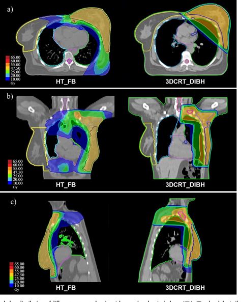 Figure From A Dose Planning Study For Cardiac And Lung Dose Sparing