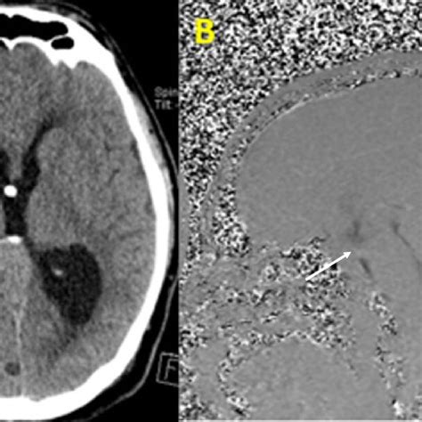 A Postoperative Ct Brain Showing The Evd Tip White Arrow Passing Download Scientific Diagram