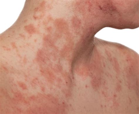 Eczema; Causes, Signs And Symptoms, Treatments And Prevention. - INFORMATION NIGERIA