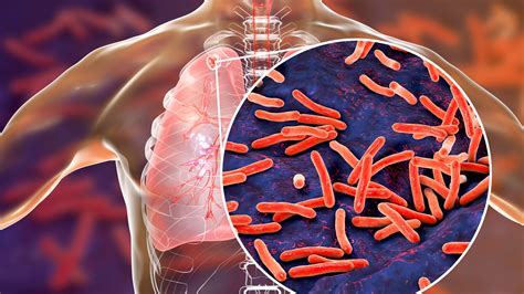 Posibles Respuestas Inmunes A La Tuberculosis Noticias En Salud