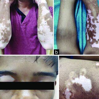 (a) Segmental vitiligo. (b) Generalized vitiligo vulgaris. (c ...