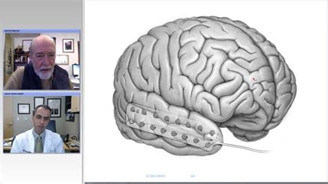 Grand Rounds-Medial Temporal Lobe Epilepsy: Evaluation | Grand Rounds ...