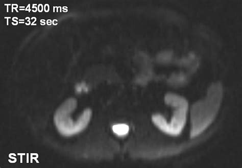 Characterization Of Genitourinary Lesions With Diffusion Weighted