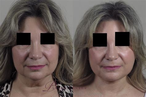 Facelift Before And After Pictures Case 1313 Paramus Nj Parker Center For Plastic Surgery