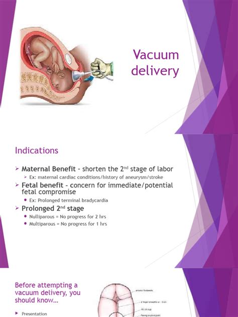 vacuum delivery | PDF | Medical Specialties | Childbirth