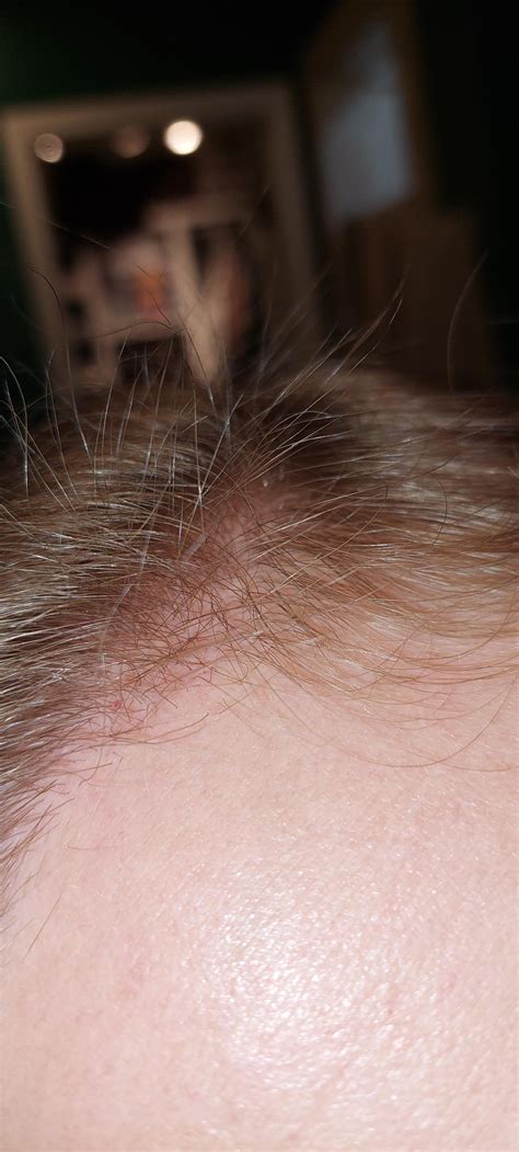 vitamin D hair growth, I believe. Hope so at least. : r/FemaleHairLoss