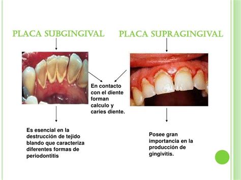 Tema Microbiologia Periodontal