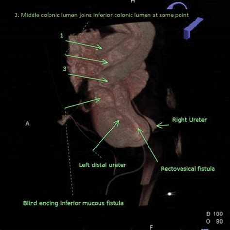 High Resolution Three Dimensional Imaging Showing Three Colonic Lumens