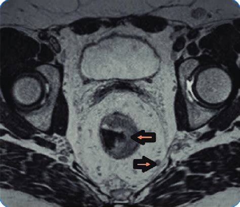 Pelvic Lymph Node Cancer Symptoms