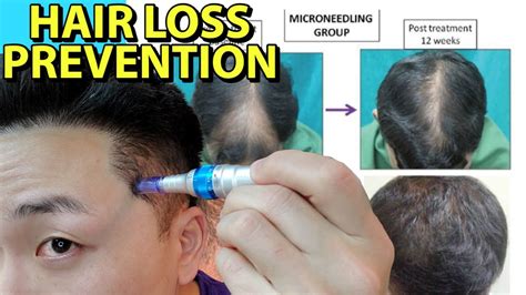 Microneedling My Scalp Every Week To Stop Hair Loss Youtube