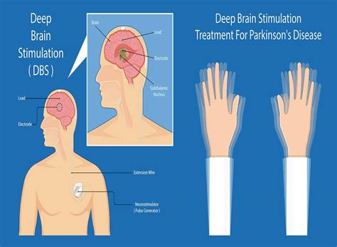 Understanding Challenges Of Neurological Disease Research