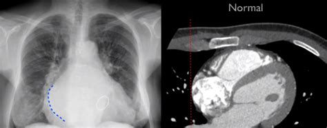 좌심방 확장left Atrium Enlargement Double Density Signdouble Contour