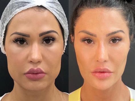 Gracyanne Barbosa Mostra Antes E Depois De Procedimentos No Rosto