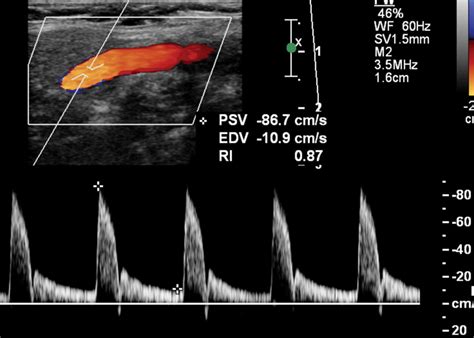 Advances In Transcranial Doppler Us Imaging Ahead Radiographics