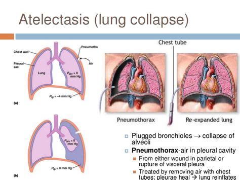 How To Correct Atelectasis