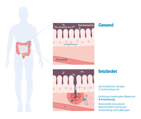 Colitis Ulcerosa Leben Mit CED