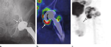 Small particle disease in a 78-year-old man with a history of rectal ...