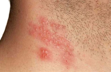 Herpes Zoster: Causes, Symptoms and Treatment