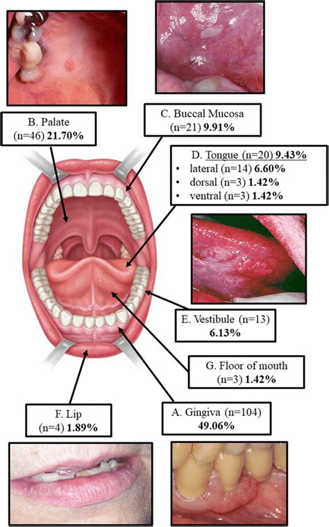 Ventral Buccal Mucosa Tongue