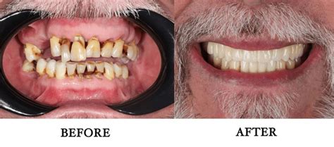 2,562 Before & After Dentures Royalty-Free Images, Stock Photos ...