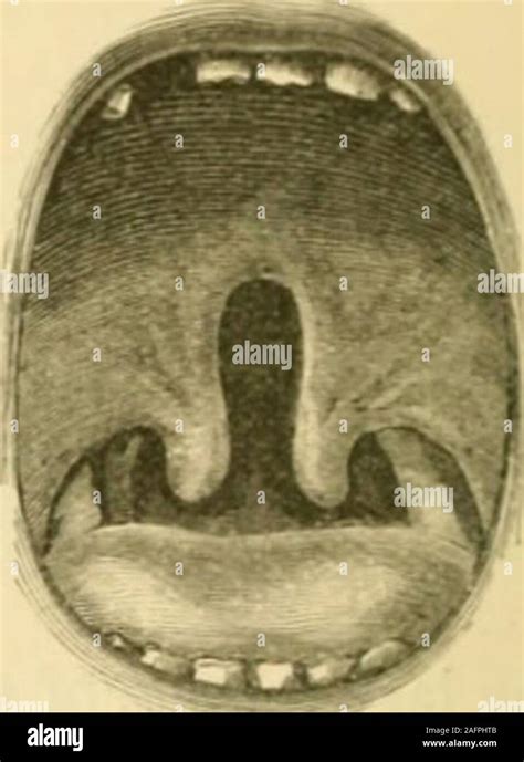 St Thomass Hospital Reports In A Third The Fissure Will Include A