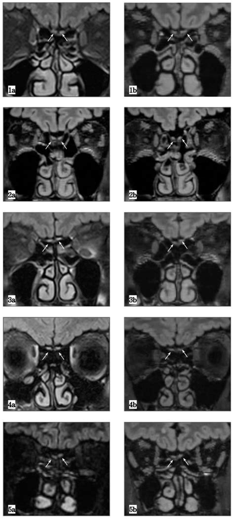 Olfactory Nerve Mri