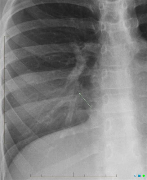 Right Middle Lobe Collapse Mucous Plugging Image