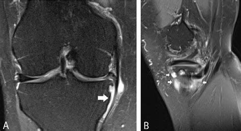 Pes Anserinus Bursa Coronal Fs T2 Wi A And Sagittal Fs T2 Wi B