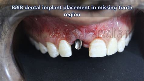 B B Dental Implants In Chennai YouTube