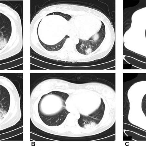 Chest Computed Tomography Scans Of The Mothers Download Scientific