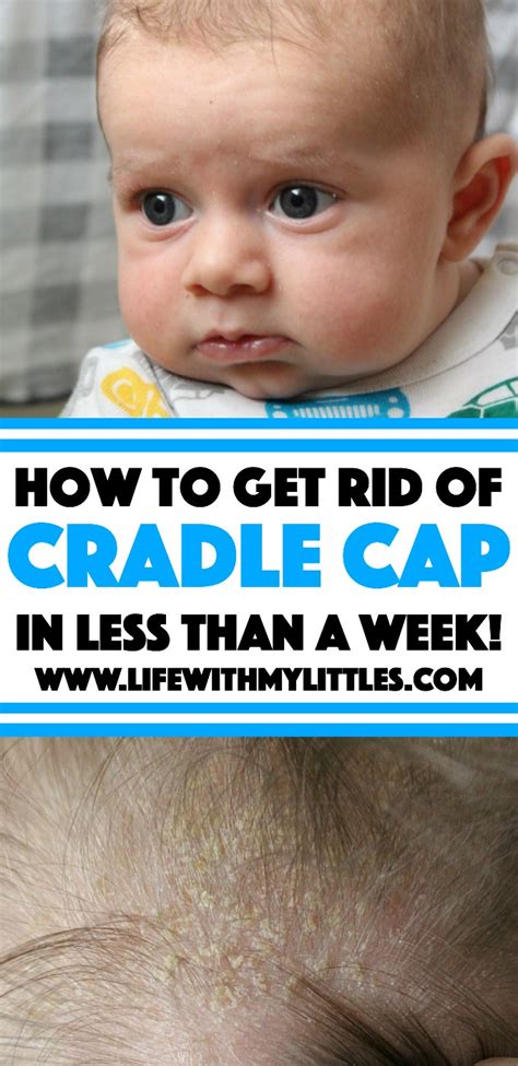 How To Get Rid Of Cradle Cap Life With My Littles