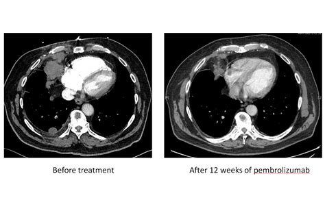 Pembrolizumab Shows Promise In Treatment Of Mesothelioma Penn Medicine