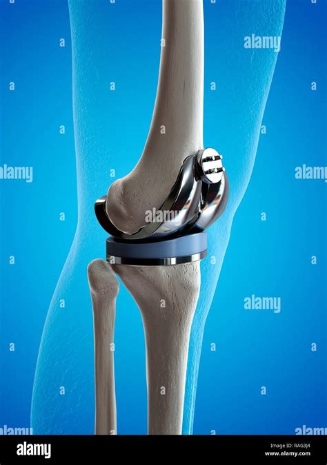 Knee Replacement Hi Res Stock Photography And Images Alamy