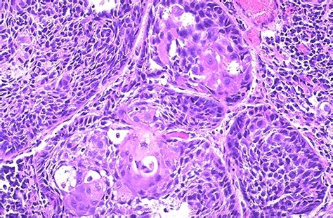 Squamous Cell Carcinoma Lung Histology