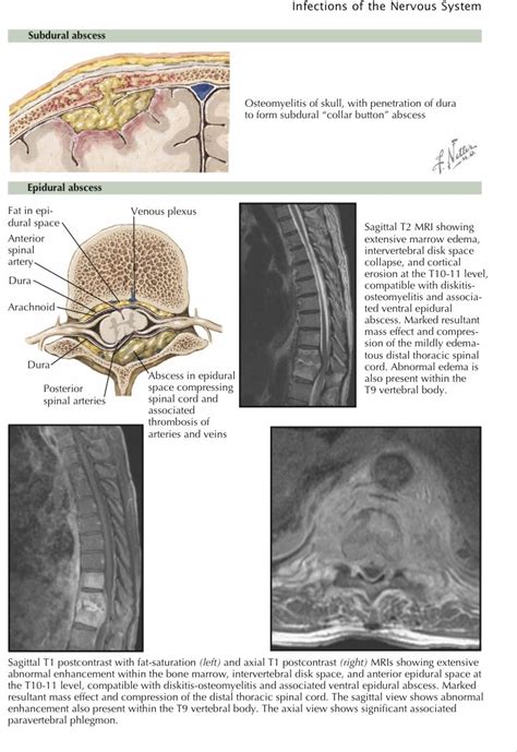 Oren Gottfried Md On Twitter Video Source Xavierferrerneuro3