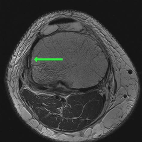 Segond Fracture - ProScan Education