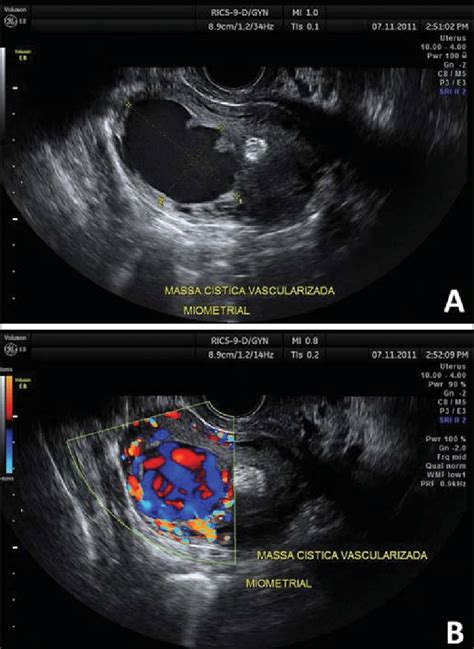 Gray Scale Transvaginal Us Demonstrating The Presence Of A Large